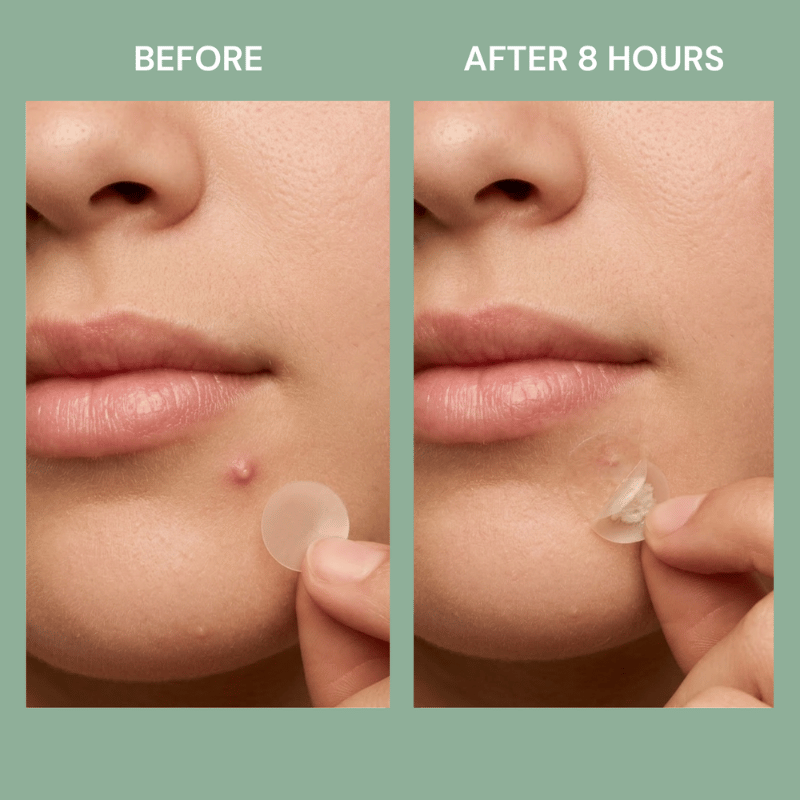 Before and after a blemish with FreshLabs Breakout Rescue Acne Patches