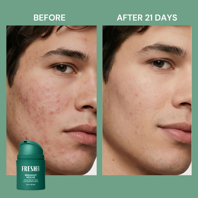FreshLabs Breakout Rescue clarifying serum lifestyle shot